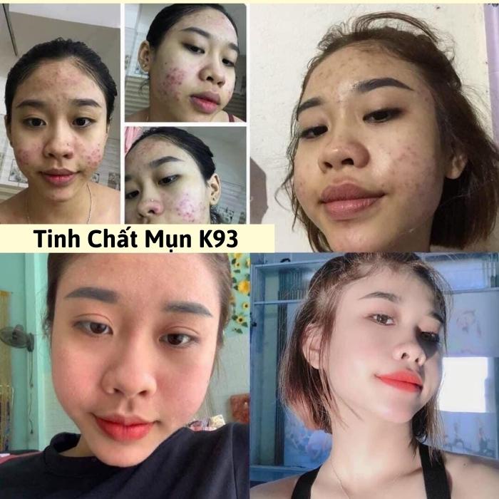 Tinh Chất Mụn K93 - Serum Giảm Mụn, Mờ Thâm Mụn Sẹo, Nâng Tông Da Công Dụng 5 Trong 1 Hiệu Quả Sau 7 Ngày-KAILY COSMETIC