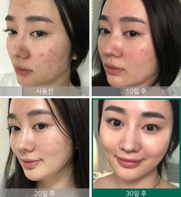 Nước hoa hồng da mụn AHA-BHA-PHA 30 Days Miracle Toner Some By Mi | BigBuy360 - bigbuy360.vn