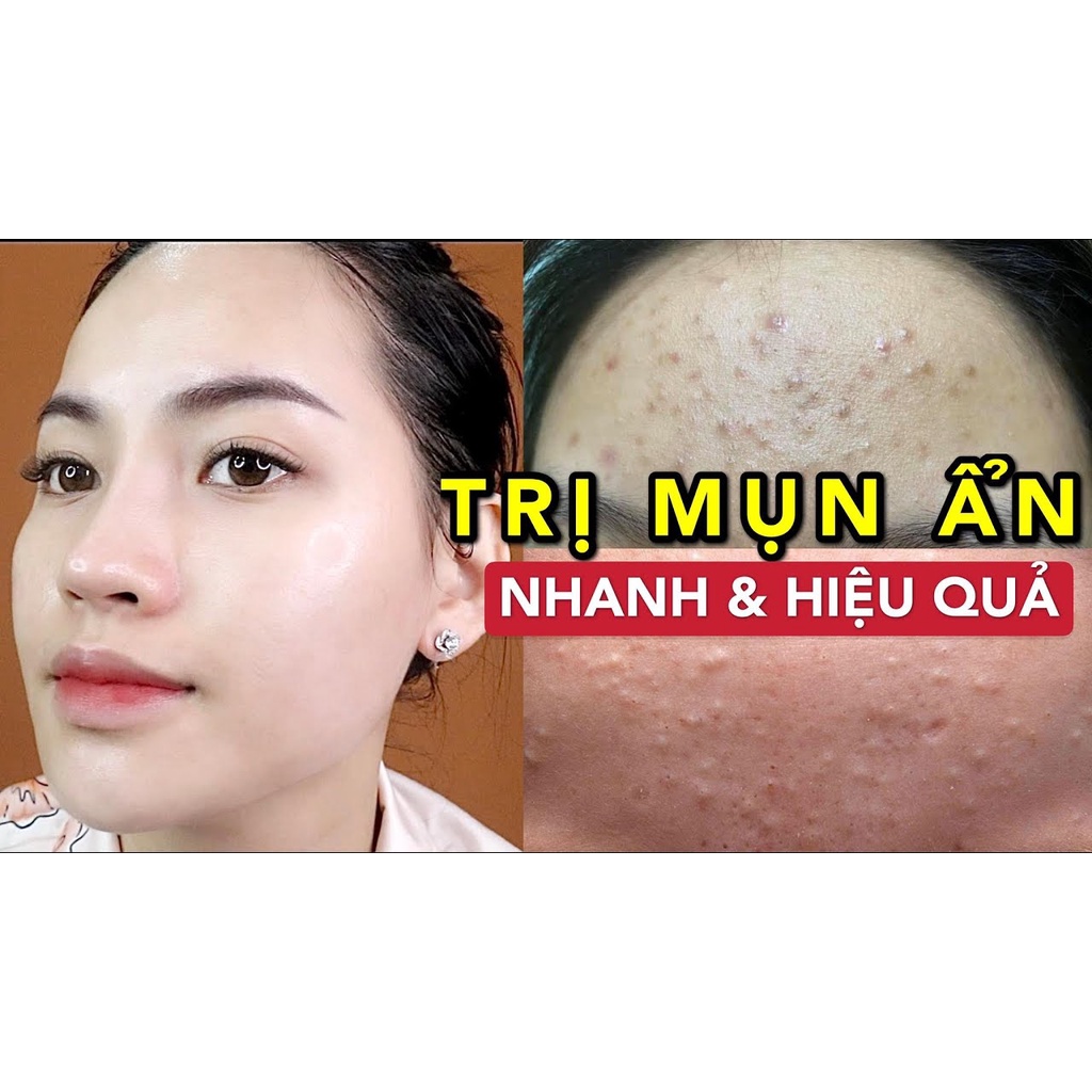 SERUM Lá nam siêu ngừa mụn - dưỡng da lành tính từ thiên nhiên 5 in 1
