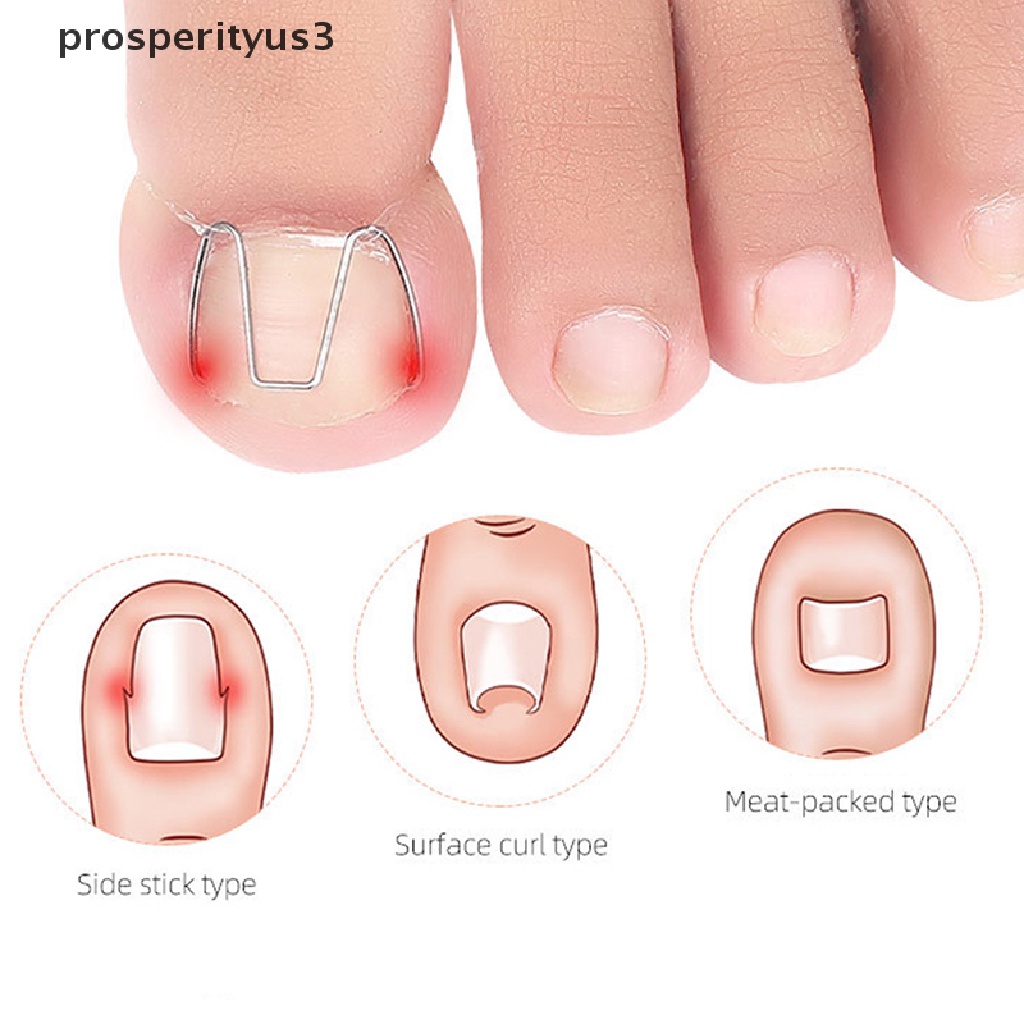 [prosperityus3] Nail Art Ingrown Toe Nail Correction Tool Toenail Nail Orthosis Paronychia Clip [new]