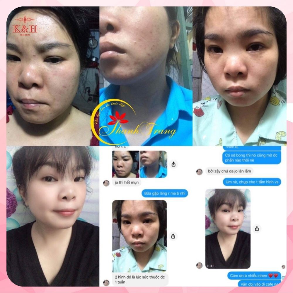 Thảo Dược Tái Tạo Da Trừ Mụn Thâm Nám Sẹo Rỗ Thanh Trang | BigBuy360 - bigbuy360.vn