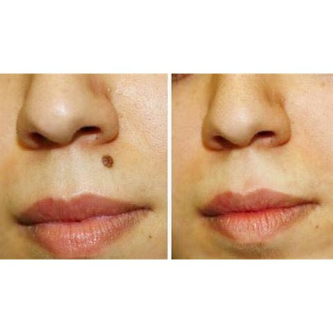 Dung dịch diệt mụn cơm, mụn cóc, sạn cá, mụn thịt của nga, sẵn hàng | BigBuy360 - bigbuy360.vn