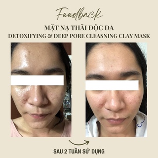 COMBO mặt nạ thải độc da - mặt nạ giảm mụn handmade