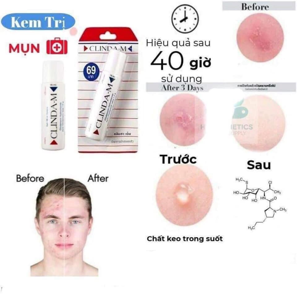 Chấm Mụn Clinda M Thái Lan 15ml (Bill Thái)