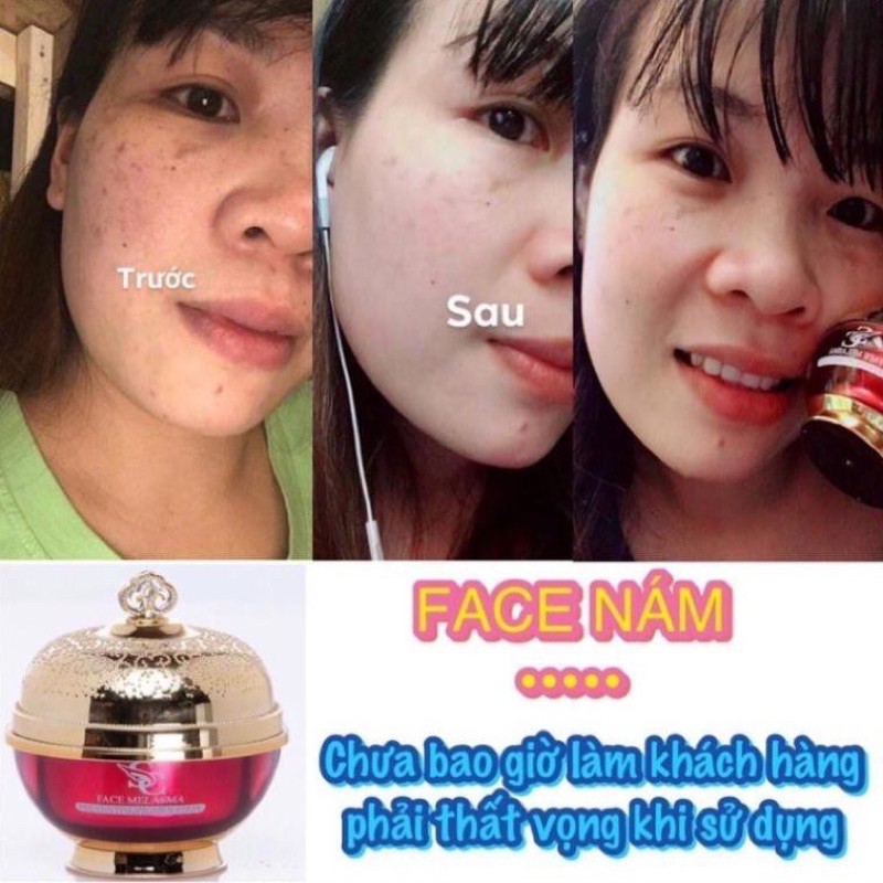 [FREE SHIP] Face melasma cream, Kem face Nám sica white, kem loại bỏ Nám