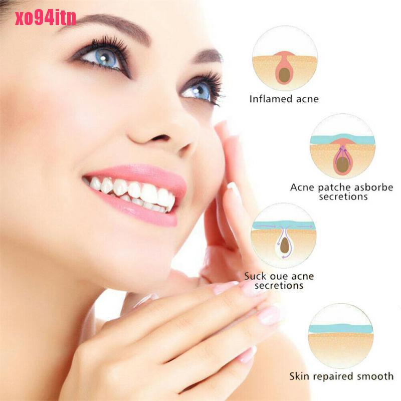 [Hàng mới về] Set 36 miếng dán hỗ trợ giảm mụn hydrocolloid hiệu quả