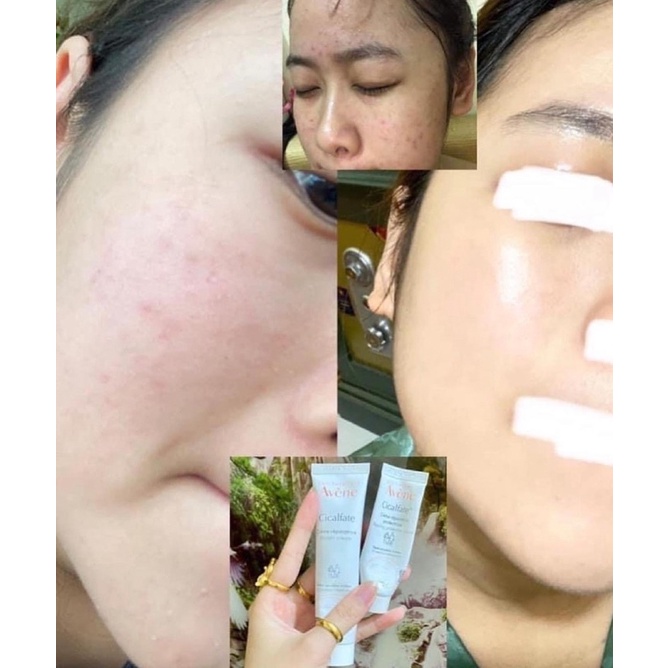 [FREE SHIP] Kem dưỡng phục hồi mờ thâm sẹo AVENE