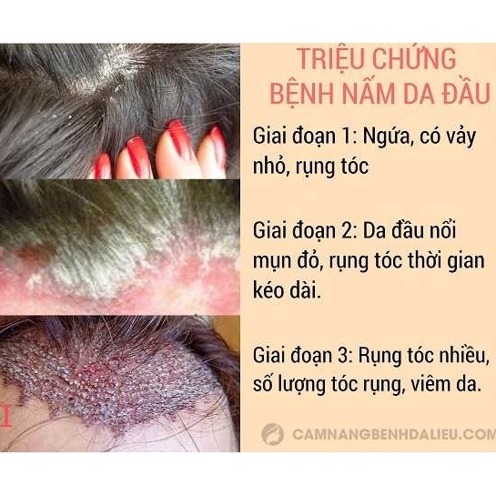Dầu gội CANDIDTV, ngăn ngừa nấm da đầu, hỗ trợ giảm tình trạng viêm da tiết bã, gầu. | BigBuy360 - bigbuy360.vn