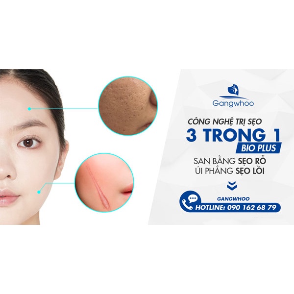 Dịch vụ làm đầy sẹo lõm tại Gangwhoo