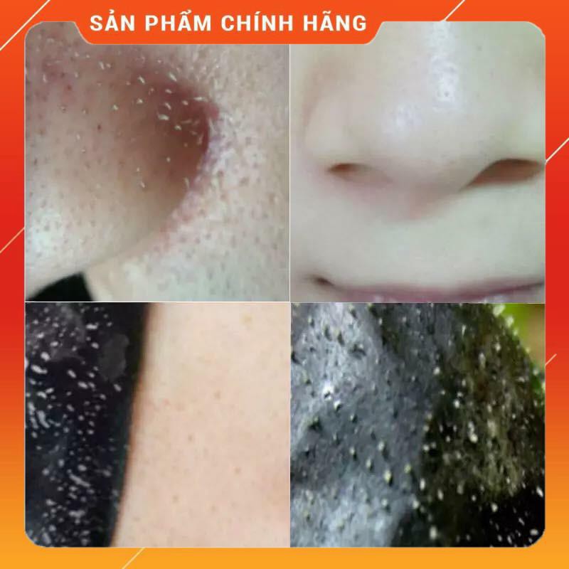 Lột Mụn Than Tre Và Trà Xanh , cam , cà phê