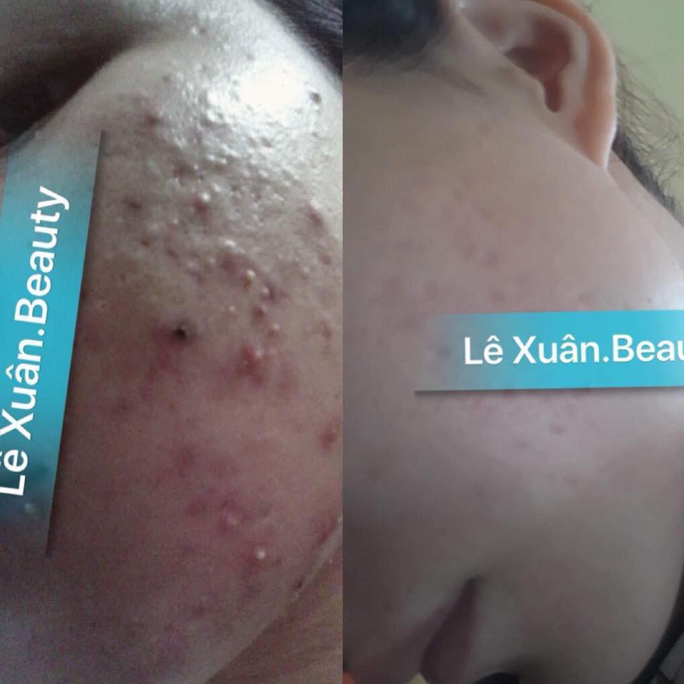 TINH CHẤT MỤN TRỨNG CÁ LÊ XUÂN💚FREESHIP💚Đánh bay mụn ẩn, mụn dầu đen, mụn trứng cá... sáng mịn da, khít lỗ chân lông | BigBuy360 - bigbuy360.vn