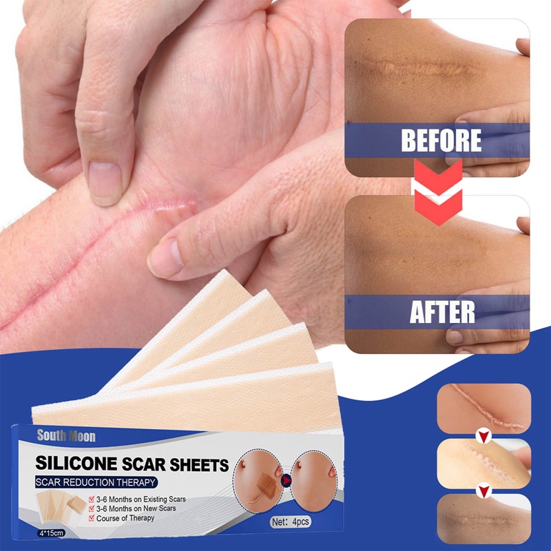 Miếng Dán Silicone Gel Hỗ trợ giảm sẹo Mụn Hiệu Quả