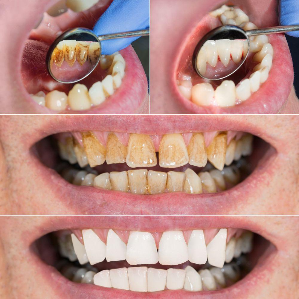 CABEZA Máy Cạo Răng Làm Sạch Răng Bằng Sóng Siêu Âm Sạc Cổng USB