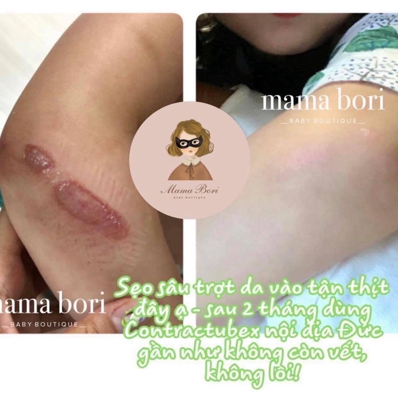 Kem bôi sẹo Contractubex nội địa Đức tuýp 30g
