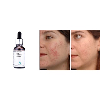 Serum Acne Dew&Dew Hàn quốc