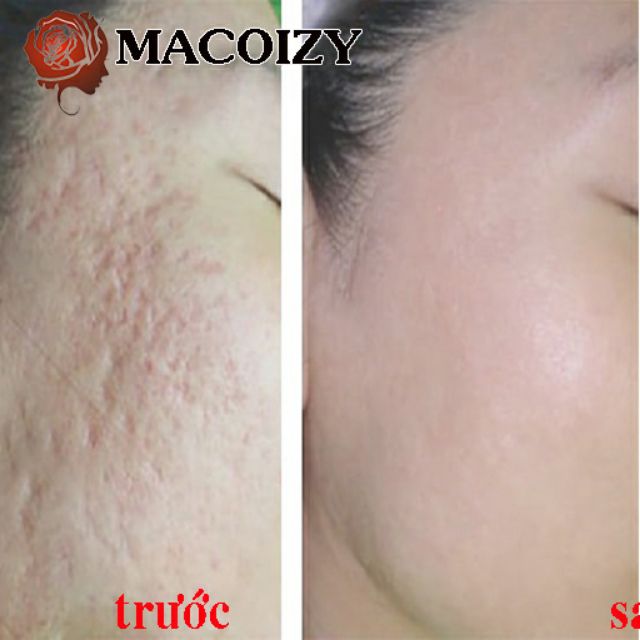 Serum Sẹo Rỗ Tái Tạo Da Se Khích Lỗ Chân Lông