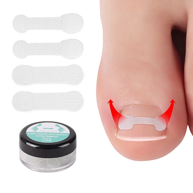 Hộp 10 Miếng Dán Điều Chỉnh Móng Chân Tiện Lợi