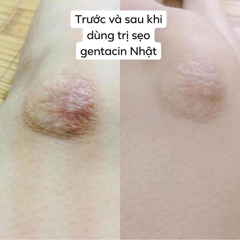 Kem Ngừa Sẹo Gentacin Nhật Bản | BigBuy360 - bigbuy360.vn