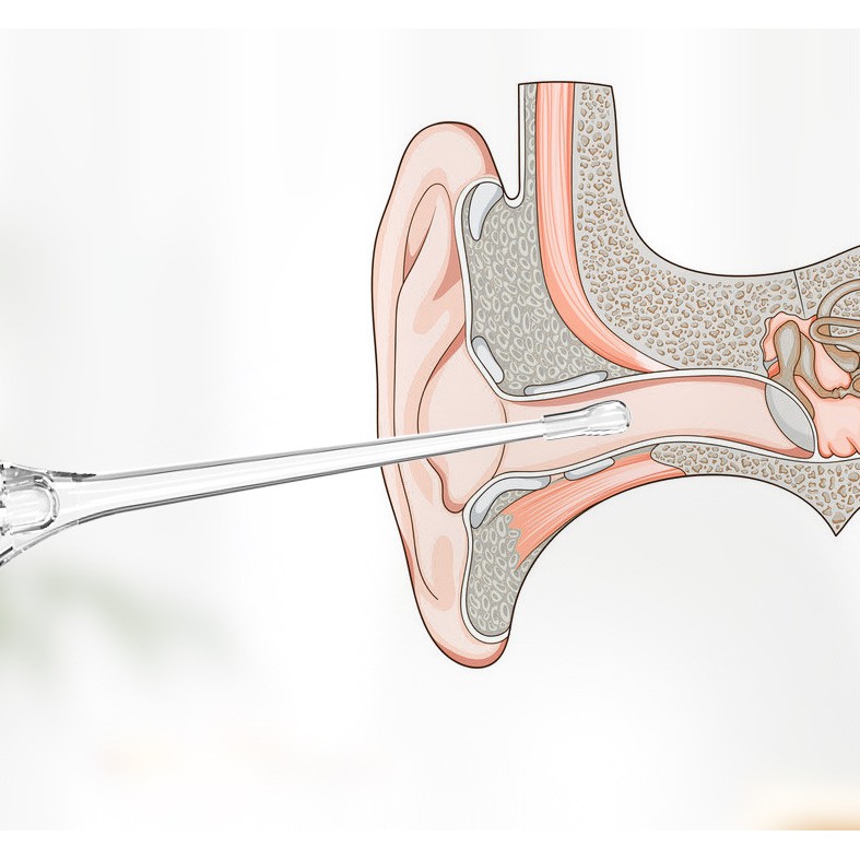 Dụng cụ lấy ráy tai có đèn dạ quang trong suốt cho bé sơ sinh