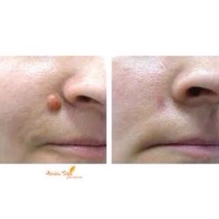 Máy đốt mụn thịt,mụn cóc,nám,tàng nhanh M-370