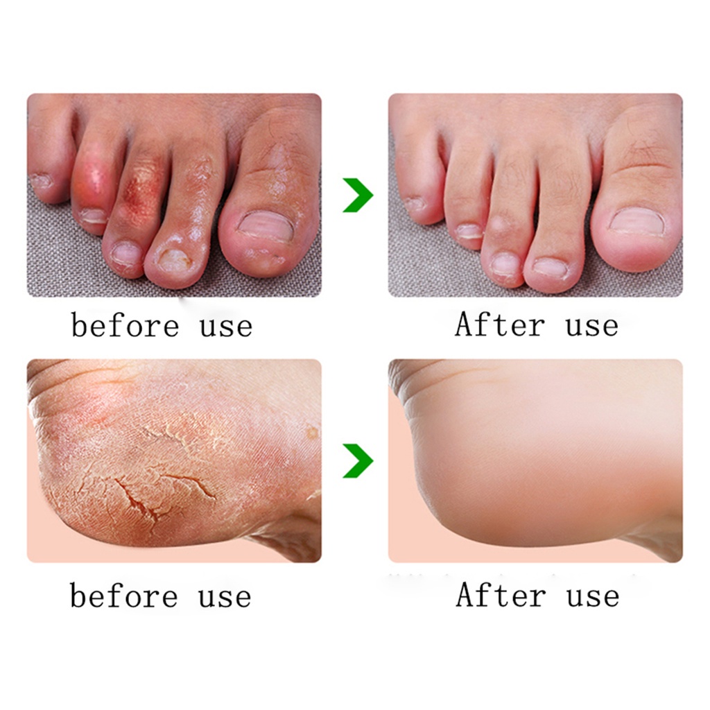 Kem dưỡng da bàn chân nứt nẻ Tẩy da chết gót chân và điều trị nếp nhăn ở tay Điều trị chống nứt nẻ da tay