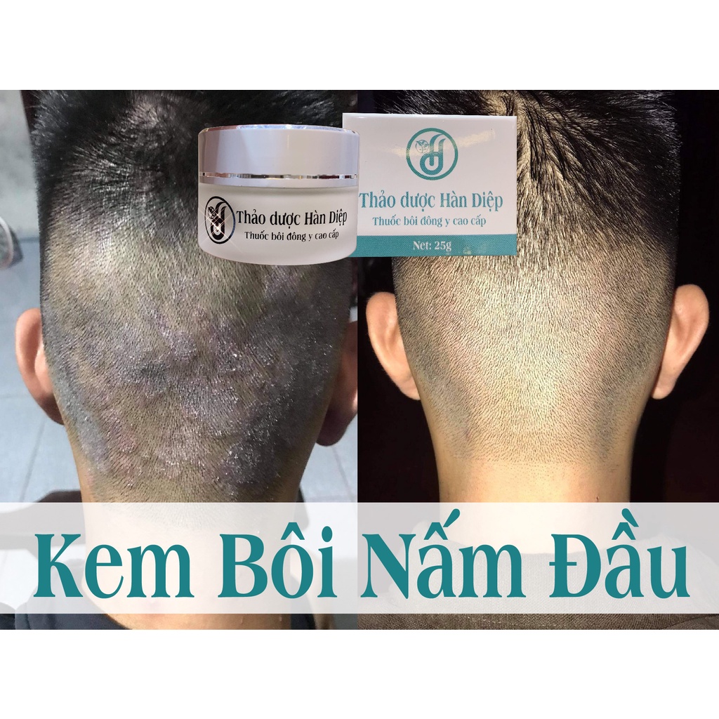 Kem bôi Nấm đầu - Nấm da đầu [ Hiệu quả 100% ]