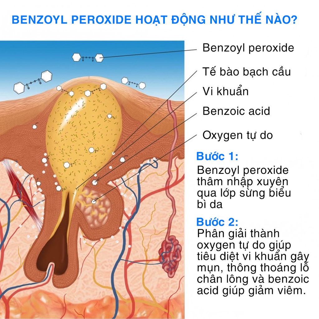 EZOYB 5-10 - Gel làm giảm và ngăn ngừa mụn Benzoyl peroxide 5%, 10%