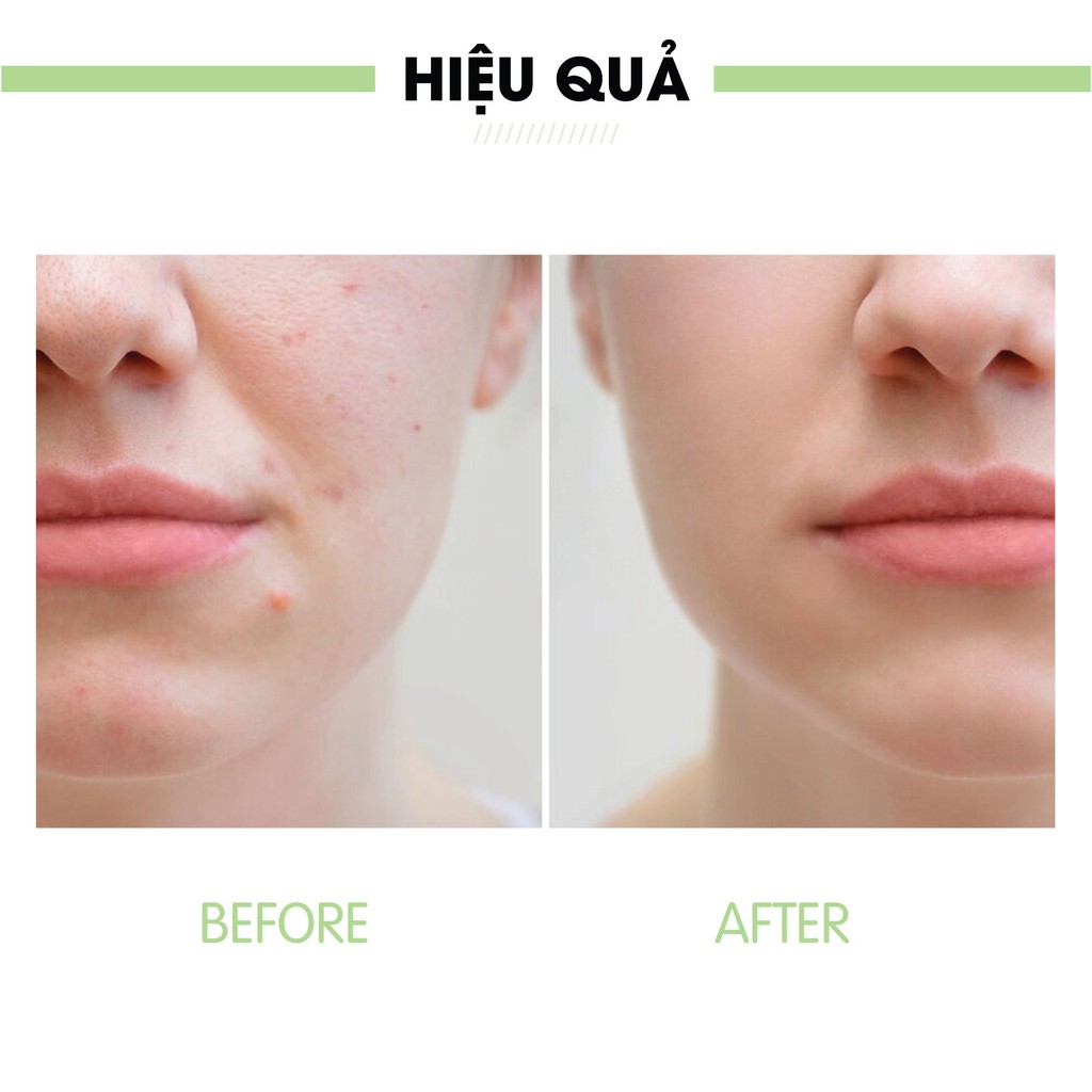 Kem ngăn ngừa và giảm mụn Truesky giúp giảm các loại mụn và bảo vệ da khỏi vi khuẩn 10g - Moisturizing Acne