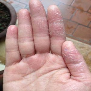 Kem bôi ngoài da tri á sưng, ngứa,hắc lào, nâm da, mề đay...