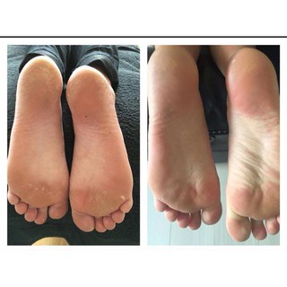 KEM TRỊ NỨT GÓT CHÂN - EPOCH SOLE SOLUTION FOOT 125ML