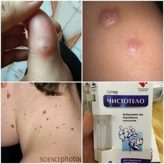 Thuốc xóa nốt ruồi - mụn thịt - mụn cóc - mụn cơm