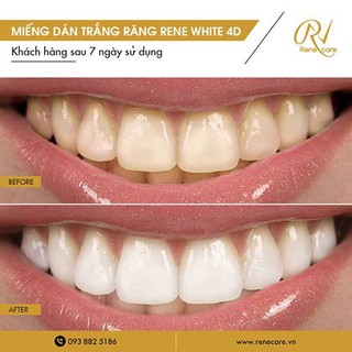 Miếng Dán Trắng Răng Rene White 4D