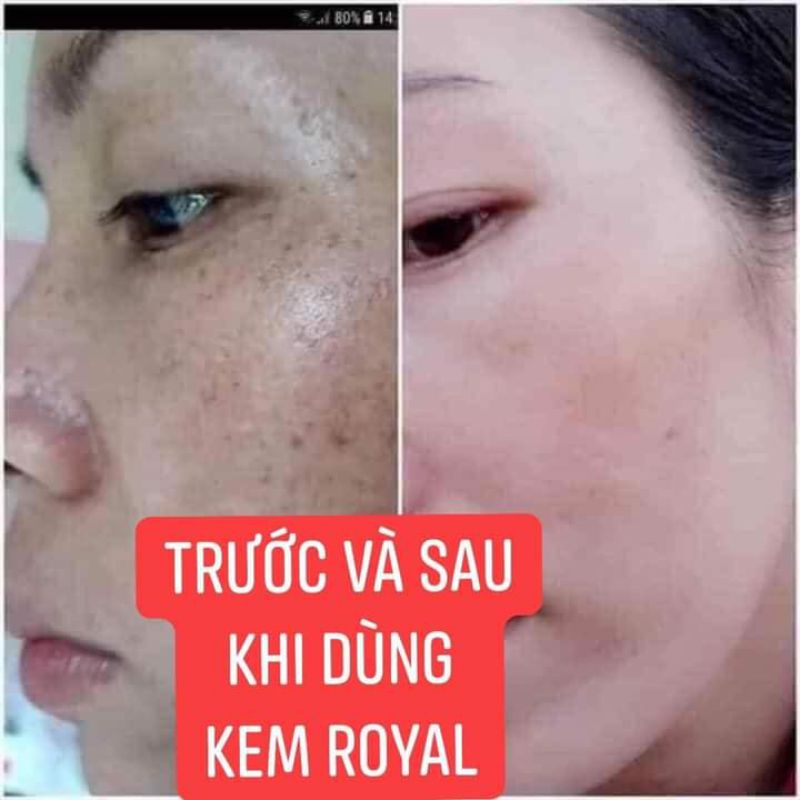 Kem nám Royal, dưỡng trắng, mờ nám,tàn nhang,thâm mụn