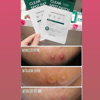 Miếng dán che mụn cấp tốc Some By Mi Clear Spot Patch 18 Miếng Auth Hàn Quốc