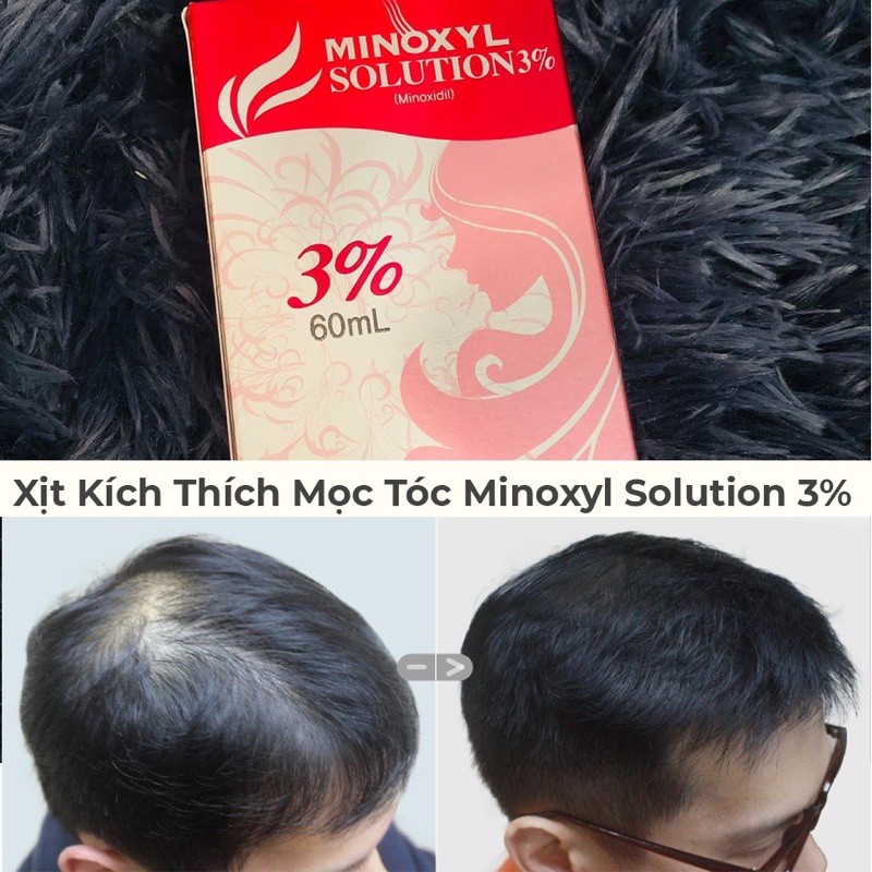 Xịt Mọc Tóc Minoxyl Solution 3% Giảm Rụng Tóc_Hói Đầu - Dung Dịch Dùng Ngoài dạng xịt_Chai 60ml