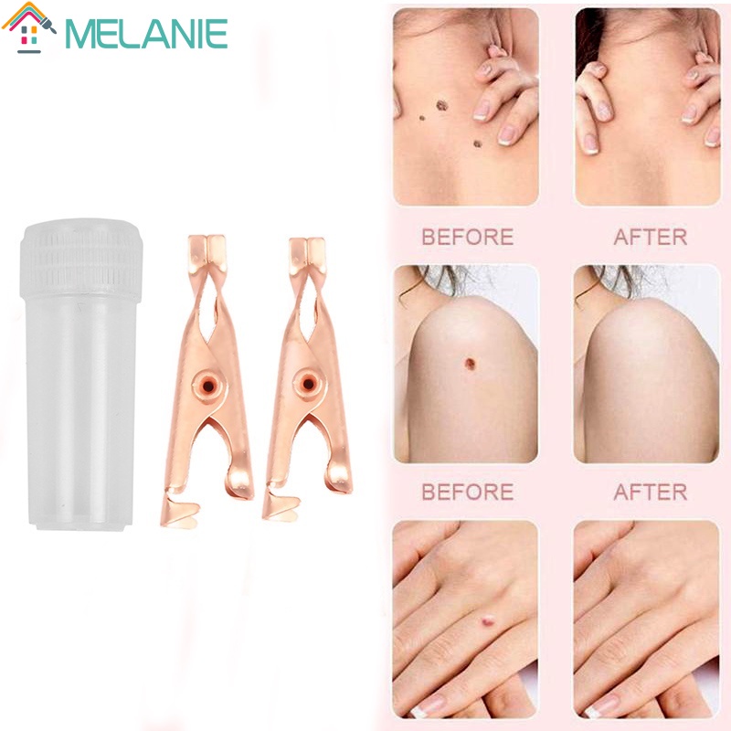Bộ 2 Kẹp Loại Bỏ Mụn Trứng Cá / Vết Thâm Tức Thì Tiện Dụng Cho Mọi Lứa Tuổi