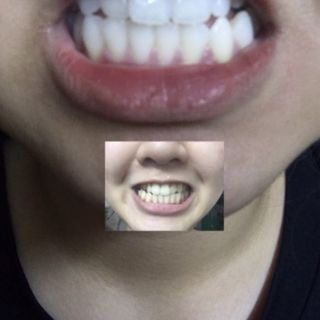 [ 1 GÓI ] Miếng dán trắng răng ❤ FREESHIP ❤ Miếng dán Crest 3D White  [Hàng Mỹ] - Miếng dán trắng răng Crest