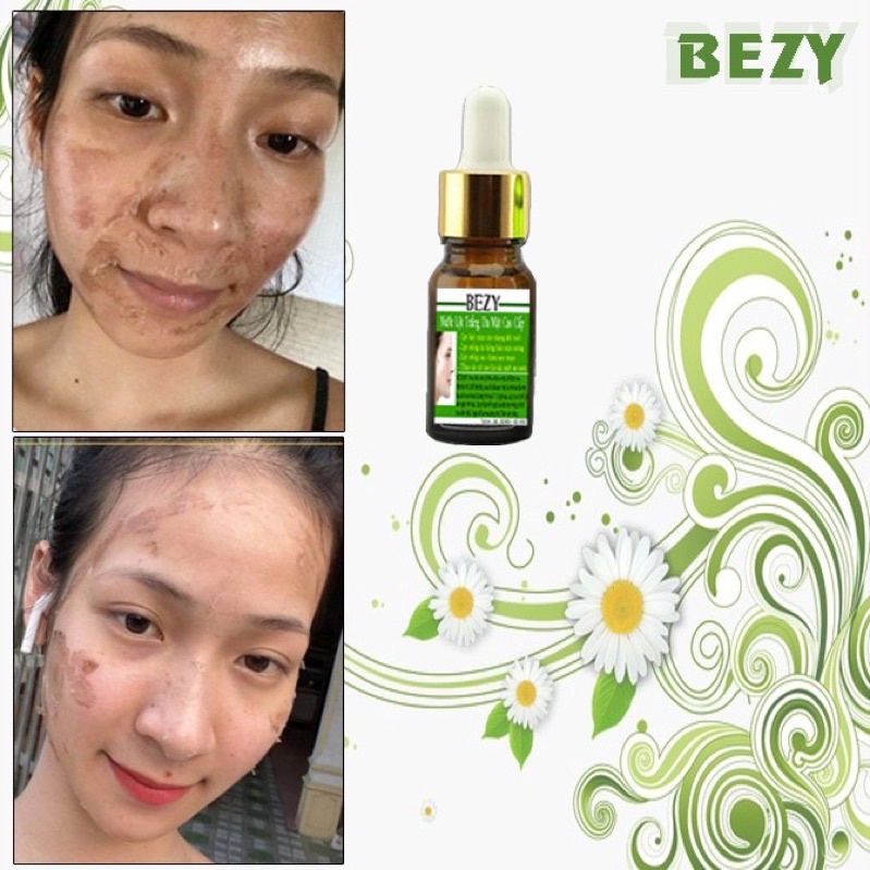 Tái Tạo Lột Thay Da Trắng Hết Nám Bezy