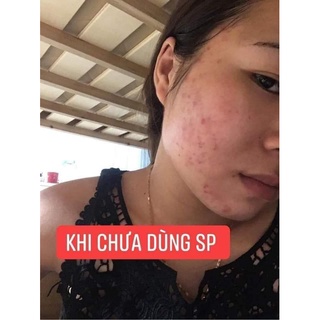 [HÀNG CHÍNH HÃNG] Serum Cốt Mụn Bạch Sen LSKIN - Mỹ Phẩm Đan Thy