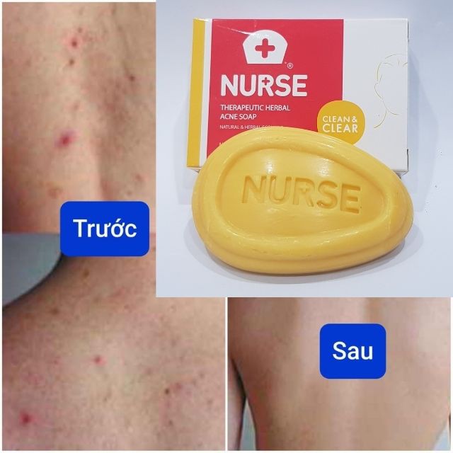 Xà Phòng Loại Bỏ Mụn Lưng Thương Hiệu NURSE Thái Lan