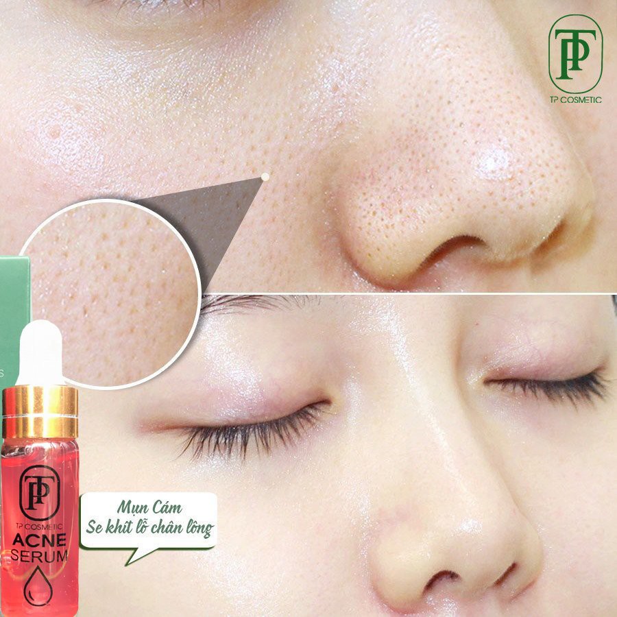 [Chính hãng] Serum truyền trắng, tri mun TP Cosmetics - Dưỡng da trắng khỏe, mun không tái phát, phù hợp với da nhạy cảm | BigBuy360 - bigbuy360.vn