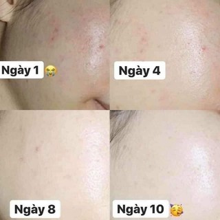 KEM A313 BẢN NỘI ĐỊA PHÁP (RETINOL A313)