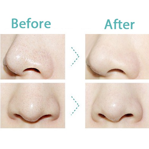 Bộ Sản Phẩm Làm Sạch Mụn Đầu Đen 3 Bước Holika Holika