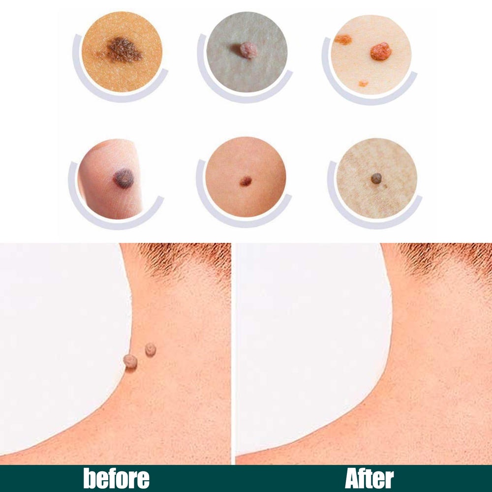 Set 120 Miếng Dán Hỗ Trợ Giảm Mụn Chăm Sóc Da Chống Nhiễm Trùng