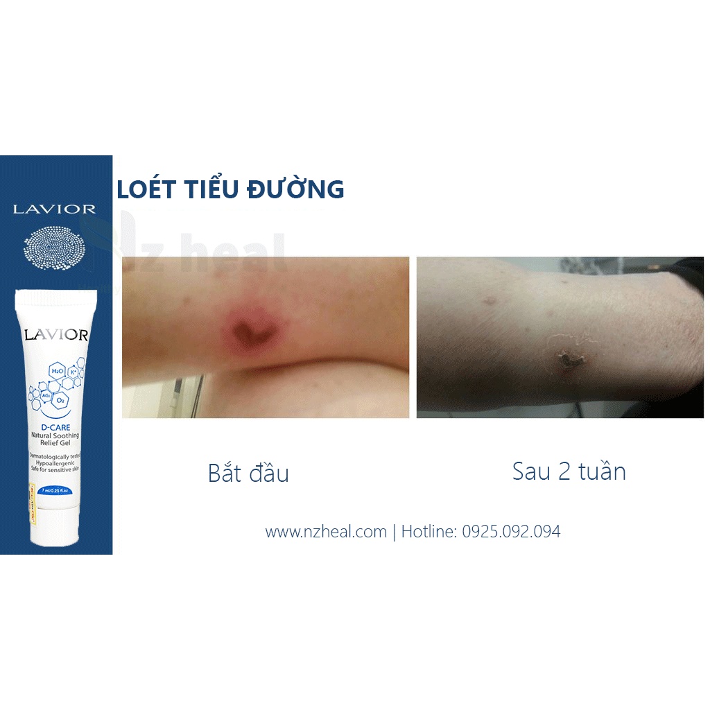 [Hỏa tốc] Lavior Diabetic Wound Gel 7ml - Làm lành vết thương, vết loét tì đè, loét chân tiểu đường, trầy xước da, bỏng