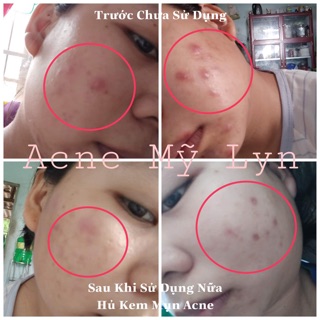 Acne Mỹ Lyn ( Kèm quà tặng )