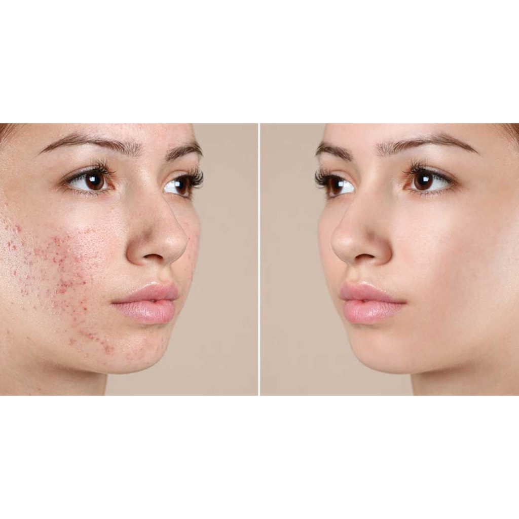 Kem ngăn ngừa mụn Mian 12gr đánh bay các loại mụn freeship extra | BigBuy360 - bigbuy360.vn