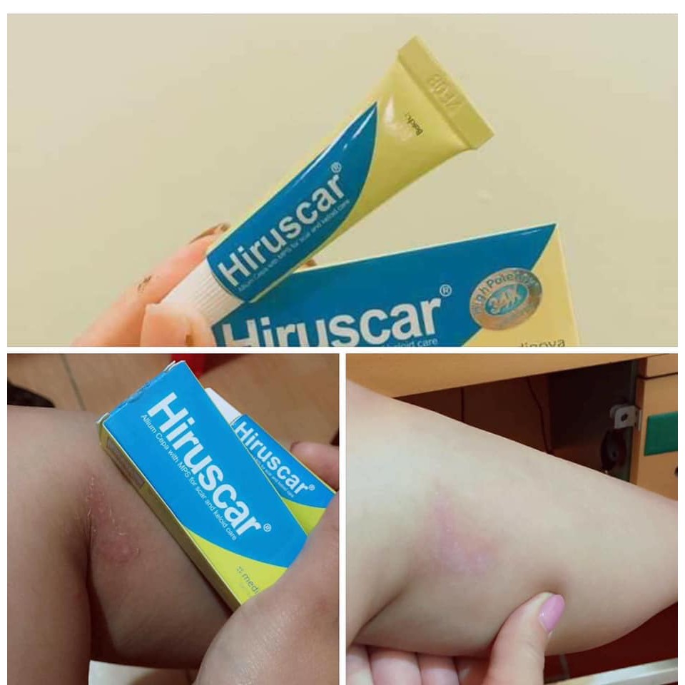 KEM TRỊ SẸO HIRUSCAR