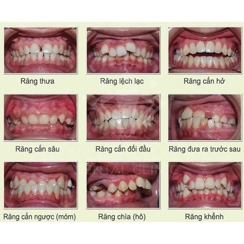 Bộ Dụng Cụ Niềng Răng Tại Nhà - Niềng răng trong suốt ( 3 giai đoạn A1+A2+A3 ) [FREE SHIP]