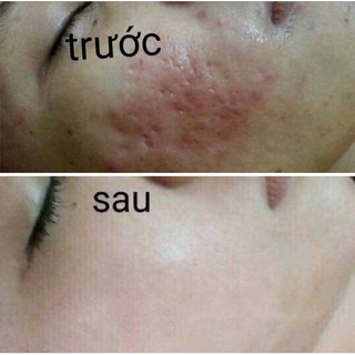 KEM TRỊ SẸO LOSHALL SCARS REMOVE